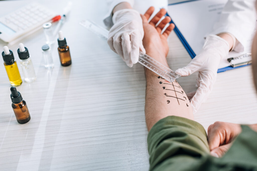overhead of allergist holding ruler near marked hand on man in clinic